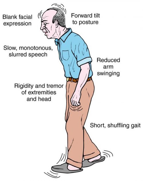 Parkinson's disease causes symptoms and treatment | Healthy Food ...