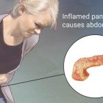 Inflammation of pancreas is called Pancreatitis.