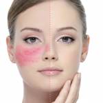 Rosacea